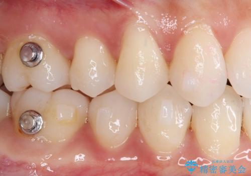 強烈な知覚過敏 歯肉移植術で根面被覆の治療前