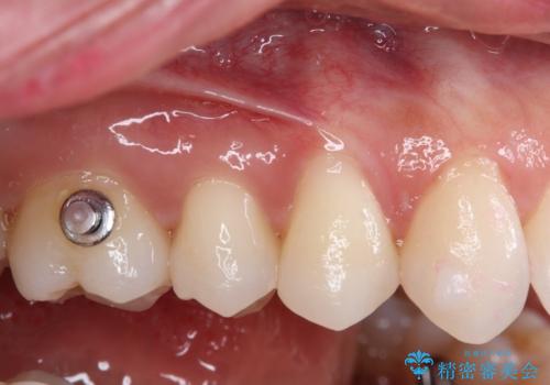 強烈な知覚過敏 歯肉移植術で根面被覆の症例 治療前