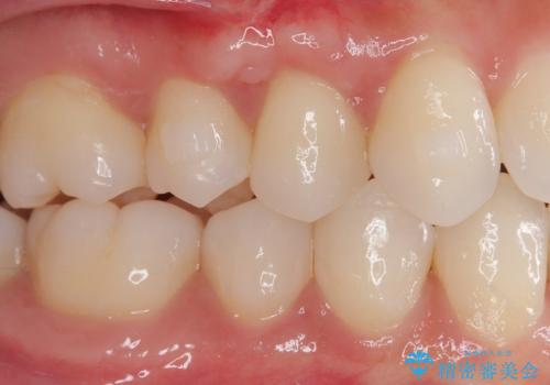 強烈な知覚過敏 歯肉移植術で根面被覆の治療後