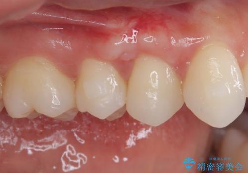 強烈な知覚過敏 歯肉移植術で根面被覆の症例 治療後