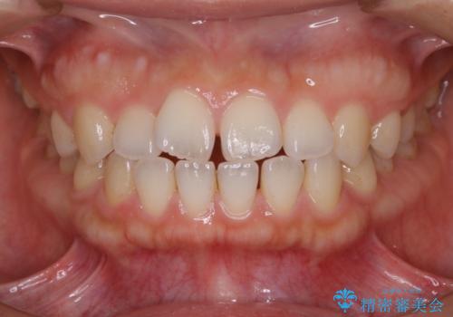 マウスピースで効率的にすきっ歯を治すの治療前