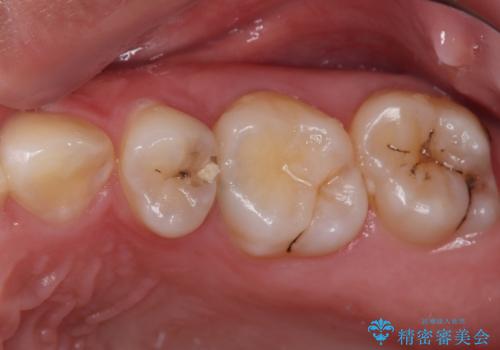 奥歯に物が挟まる　セラミックインレーでのむし歯治療の症例 治療前