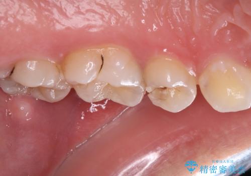 奥歯に物が挟まる セラミックインレーでのむし歯治療の治療前