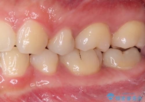 奥歯に物が挟まる セラミックインレーでのむし歯治療の治療前