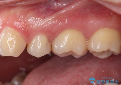 奥歯に物が挟まる セラミックインレーでのむし歯治療の治療前