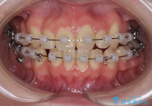 歯並びのせいで歯ブラシがしづらい　マルチブラケットを用いた抜歯矯正の治療中