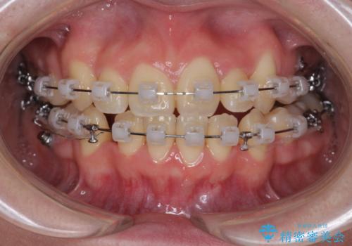 歯並びのせいで歯ブラシがしづらい マルチブラケットを用いた抜歯矯正の治療中