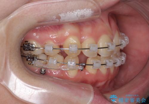 歯並びのせいで歯ブラシがしづらい マルチブラケットを用いた抜歯矯正の治療中