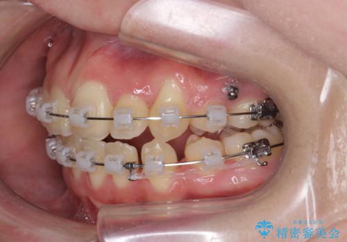 歯並びのせいで歯ブラシがしづらい マルチブラケットを用いた抜歯矯正の治療中