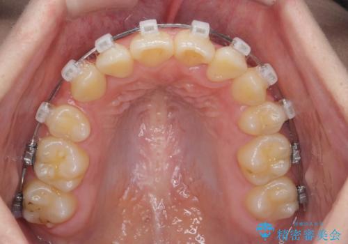 歯並びのせいで歯ブラシがしづらい　マルチブラケットを用いた抜歯矯正の治療中