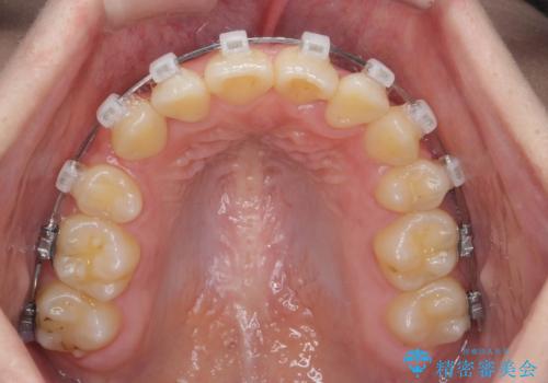歯並びのせいで歯ブラシがしづらい マルチブラケットを用いた抜歯矯正の治療中
