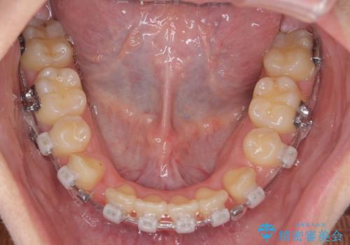 歯並びのせいで歯ブラシがしづらい マルチブラケットを用いた抜歯矯正の治療中