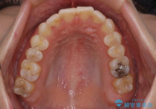 【インビザライン】上前歯1本飛び出ているのを治したいの治療後