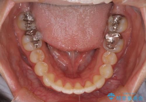 【インビザライン】上前歯1本飛び出ているのを治したいの治療後
