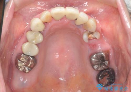 セラミック インプラント 全顎治療の治療前