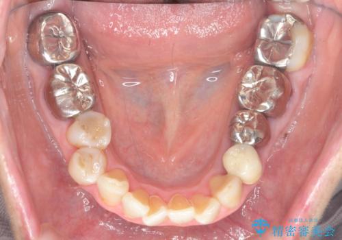 セラミック インプラント 全顎治療の治療前