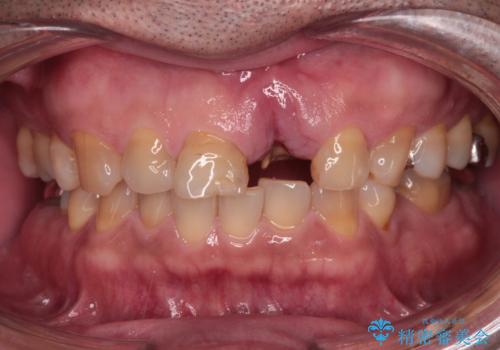 歯茎に溝が　大きく欠損した前歯のインプラント補綴治療の治療前