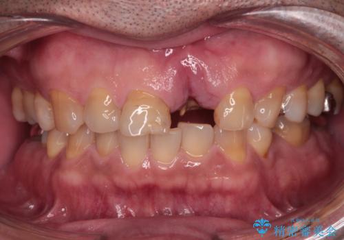 歯茎に溝が 大きく欠損した前歯のインプラント補綴治療の治療前