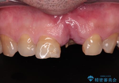 歯茎に溝が 大きく欠損した前歯のインプラント補綴治療の症例 治療前