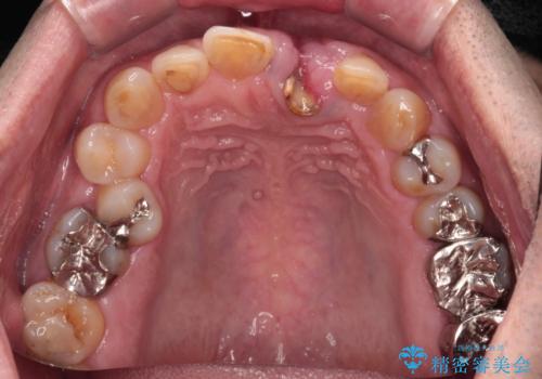 歯茎に溝が　大きく欠損した前歯のインプラント補綴治療の治療前