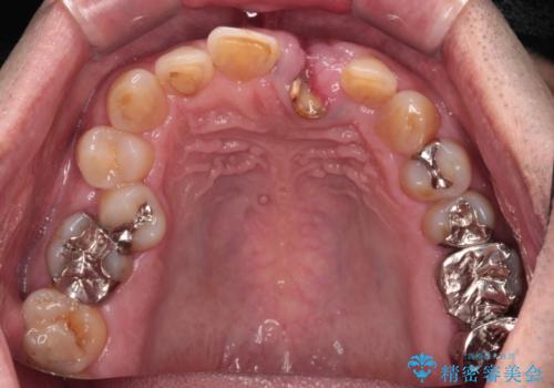 歯茎に溝が 大きく欠損した前歯のインプラント補綴治療の治療前