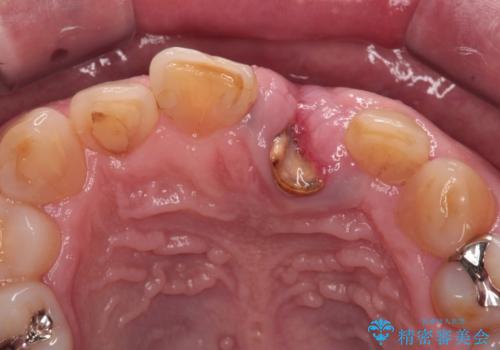 歯茎に溝が　大きく欠損した前歯のインプラント補綴治療の治療前