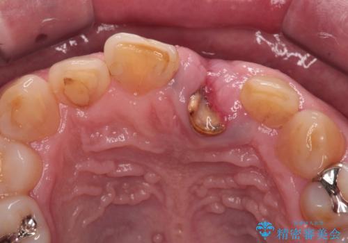 歯茎に溝が 大きく欠損した前歯のインプラント補綴治療の治療前