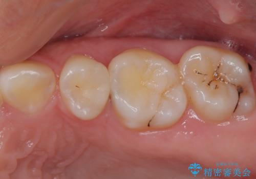 奥歯に物が挟まる セラミックインレーでのむし歯治療の症例 治療後