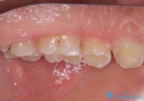 奥歯に物が挟まる セラミックインレーでのむし歯治療の治療後