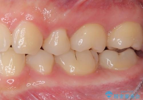 奥歯に物が挟まる　セラミックインレーでのむし歯治療の治療後