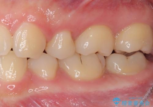 奥歯に物が挟まる セラミックインレーでのむし歯治療の治療後