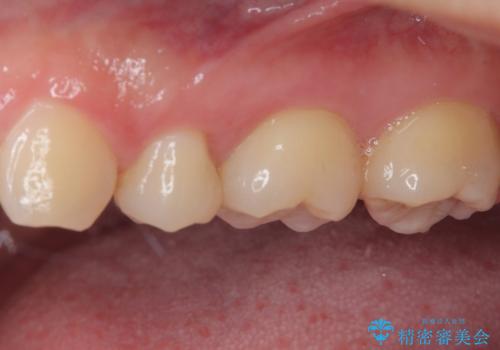 奥歯に物が挟まる　セラミックインレーでのむし歯治療の治療後