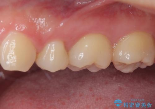奥歯に物が挟まる セラミックインレーでのむし歯治療の治療後