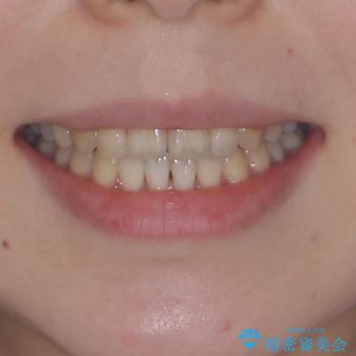 開咬をワイヤー装置で矯正治療の治療後(顔貌)