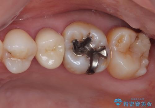 オールセラミッククラウンによる奥歯のむし歯治療の治療後
