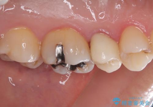 オールセラミッククラウンによる奥歯のむし歯治療の治療後