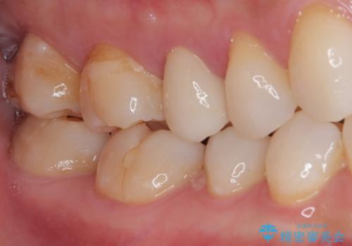 オールセラミッククラウンによる奥歯のむし歯治療の治療後