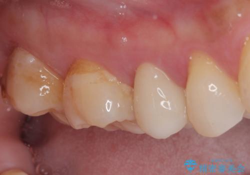 オールセラミッククラウンによる奥歯のむし歯治療の治療後