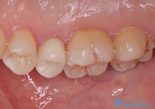 オールセラミッククラウンによる奥歯のむし歯治療の治療後