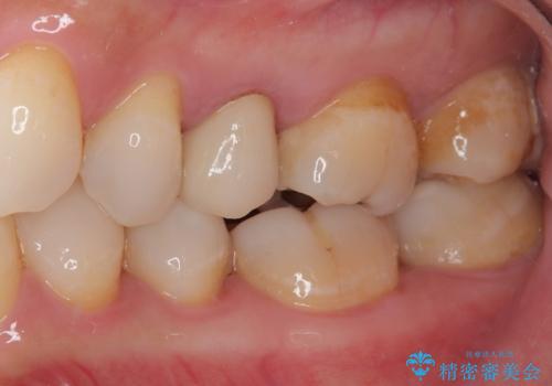 オールセラミッククラウンによる奥歯のむし歯治療の治療後