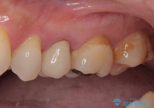 オールセラミッククラウンによる奥歯のむし歯治療の治療後