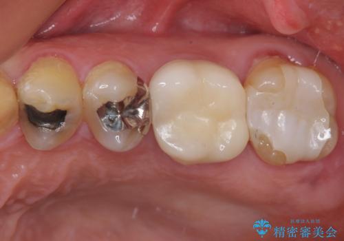 食べ物がよくはさまるのが気になる。オールセラミッククラウンによる補綴治療の症例 治療後