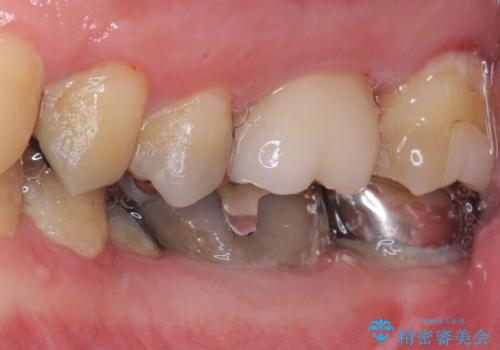 食べ物がよくはさまるのが気になる。オールセラミッククラウンによる補綴治療の治療後