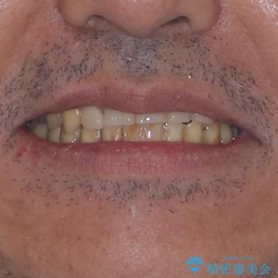 反対咬合ですり減った前歯とむし歯だらけの奥歯 総合歯科治療の治療後(顔貌)