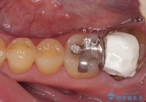 外側に飛び出している歯　部分矯正を用いた奥歯の補綴治療の症例 治療前