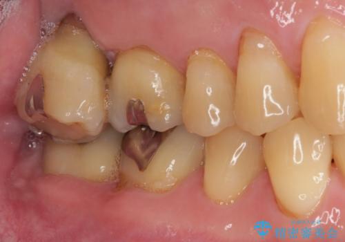 外側に飛び出している歯 部分矯正を用いた奥歯の補綴治療の治療前