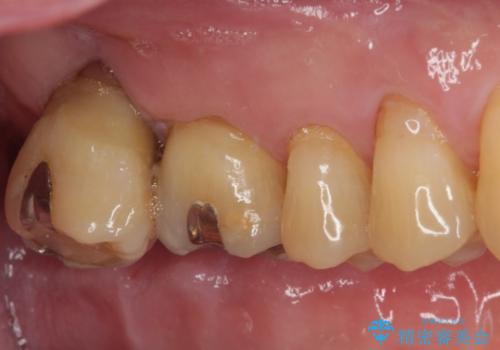 外側に飛び出している歯 部分矯正を用いた奥歯の補綴治療の治療前