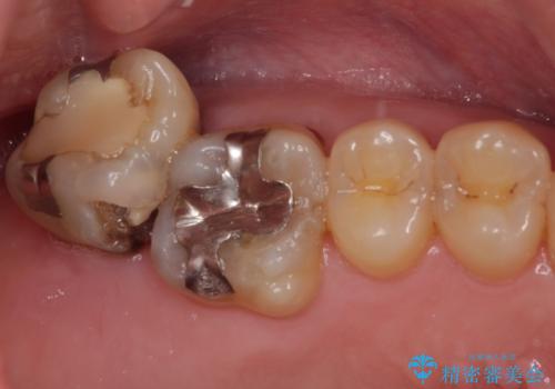外側に飛び出している歯 部分矯正を用いた奥歯の補綴治療の治療前