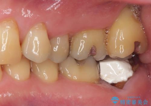 外側に飛び出している歯 部分矯正を用いた奥歯の補綴治療の治療前