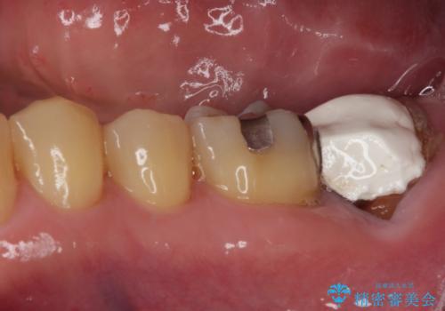 外側に飛び出している歯 部分矯正を用いた奥歯の補綴治療の治療前